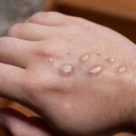 Viruela del mono en Argentina