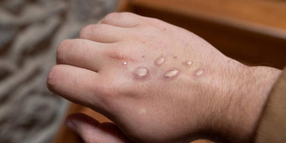 Viruela del mono en Argentina