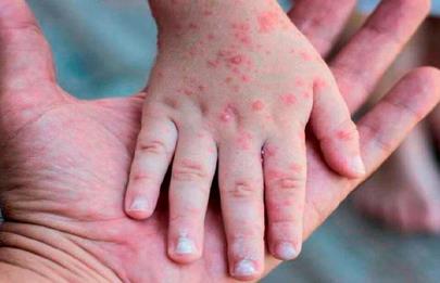 “Los equipos de salud estamos en alerta para diagnosticar nuevos casos de viruela símica”