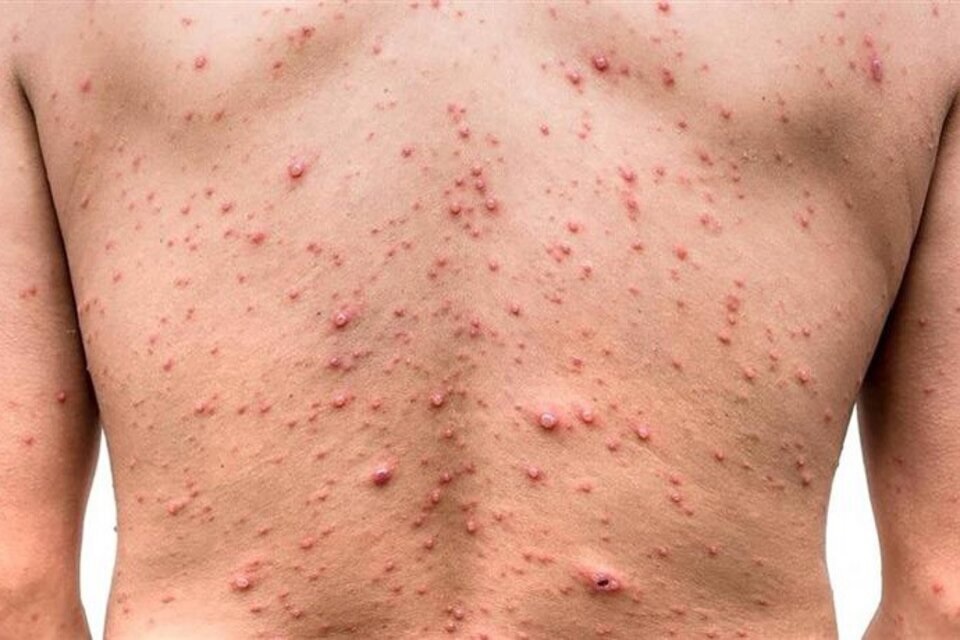 El Ministerio de Salud de la Nación reportó en lo que va de 2024 dos casos de la viruela del mono en la Ciudad de Buenos Aires