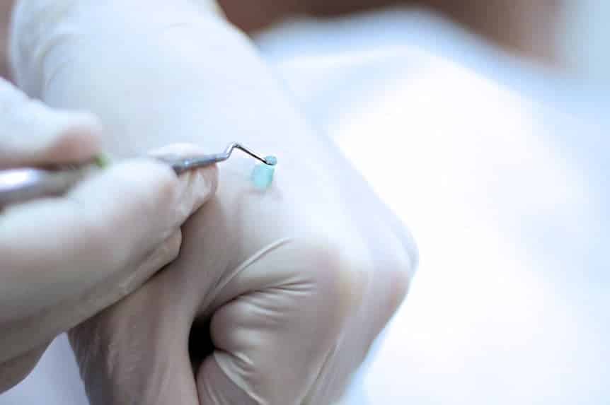 Gran innovación: Así es el gel quita caries