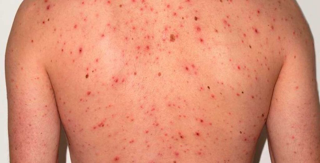 Alerta de la Sociedad Argentina de Infectología por Sarampión