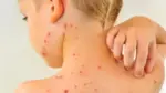 Alerta por brote de sarampión en la Ciudad