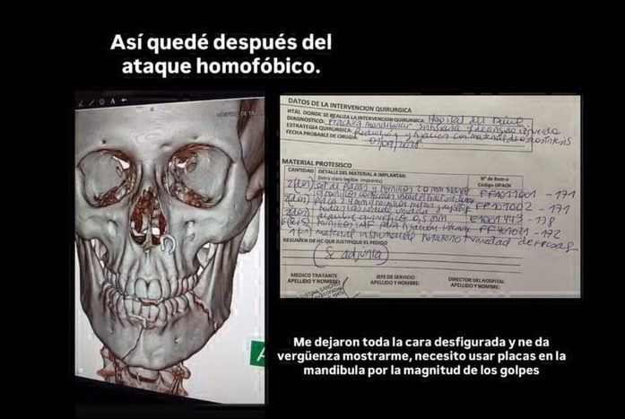 Denuncian ataque homofóbico en Palermo: a la víctima le quebraron la mandíbula y tienen que colocarle placas de metal