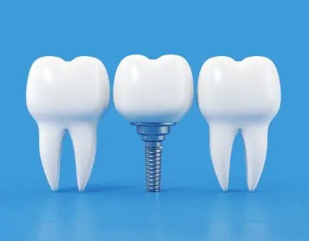 Implantes Dentales: una opción segura y efectiva 