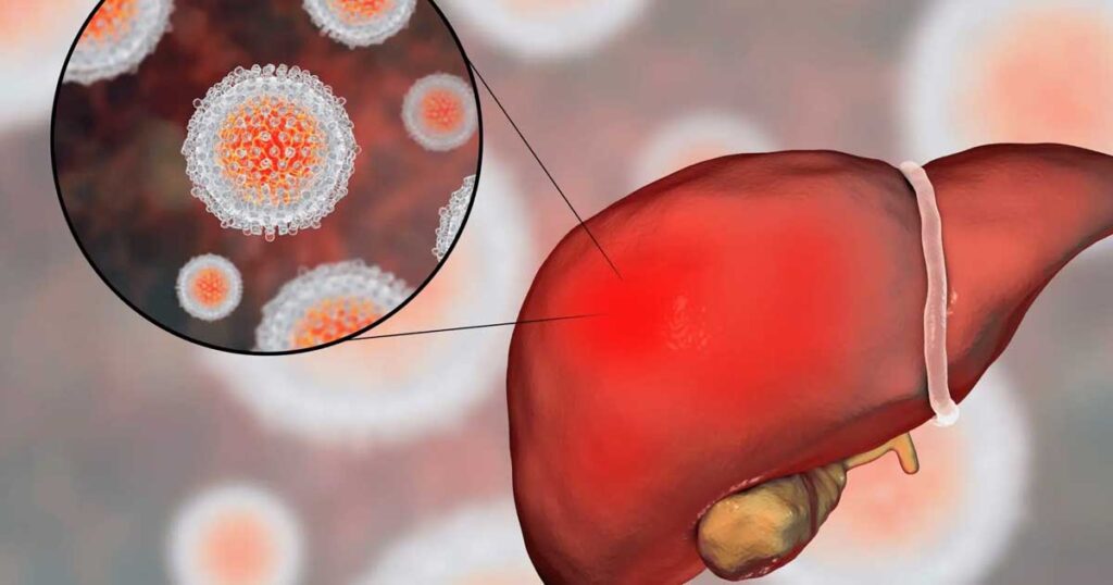Alerta sanitaria por Hepatitis A: los casos siguen en aumento y advierten un cambio en la principal vía de transmisión